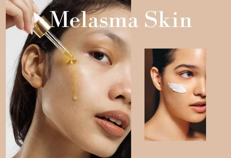 melasma treatment